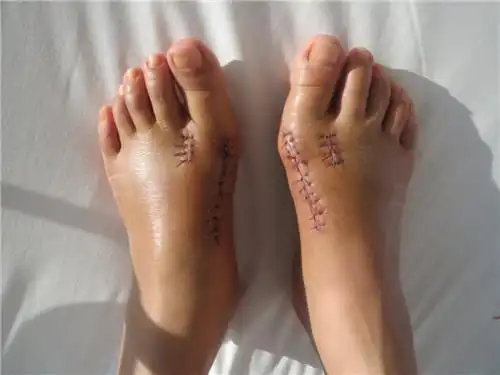 个性化手术方案治疗拇外翻