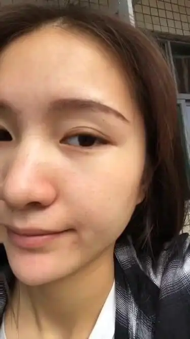 油性皮肤适合用什么痘痘肌