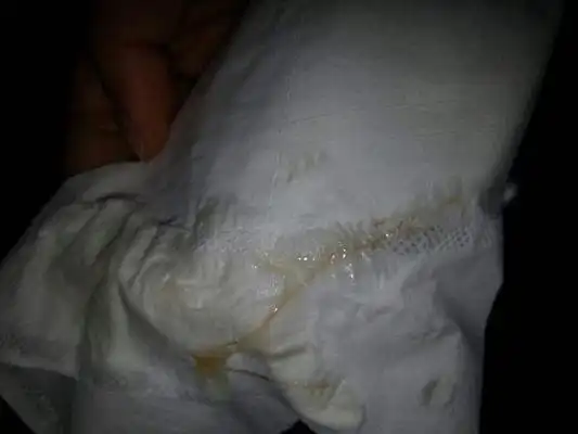 血性白带图片36