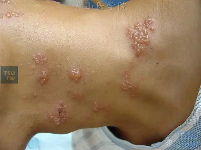 带状疱疹(herpes zoster)症状表现 - 皮肤病学 - 天山医学院