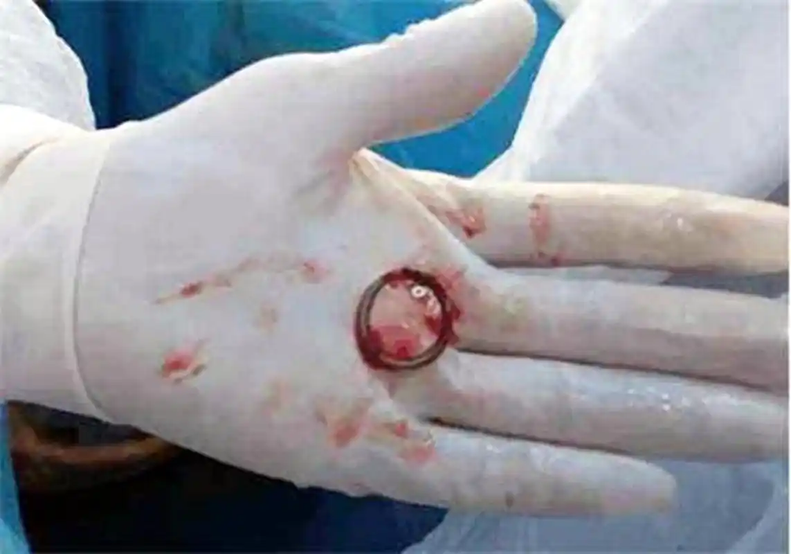 30年前第一批上环的妈妈现在怎么样了结果已被验证众人唏嘘