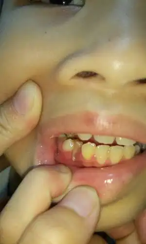 孩子9岁了,有一颗要换掉的牙齿牙龈长出来了,请问要去看医生吗