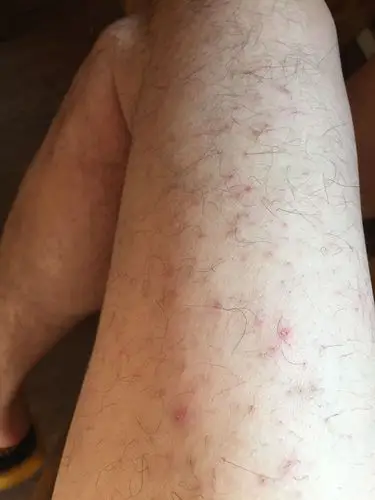 大腿外侧总起红斑,而去是汗毛根毛囊下起,汗毛下起红斑时轻轻一拽就