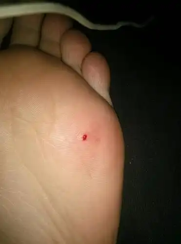 我脚上破了一个很小,像针眼那么大的小伤口,怎么样快速止血,我现在