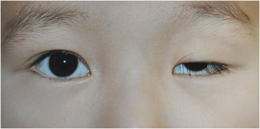 上睑下垂要矫正