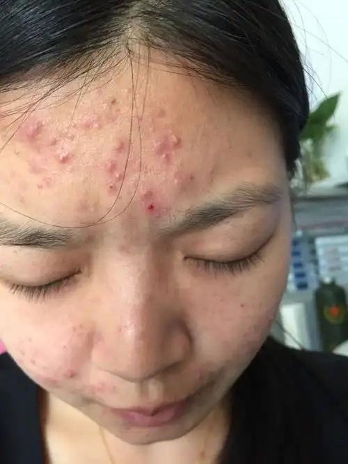 嘴周围爱长痘,吃中药一个月了,没效,还比以前长更多