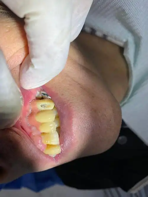 种植牙 - 春雨医生