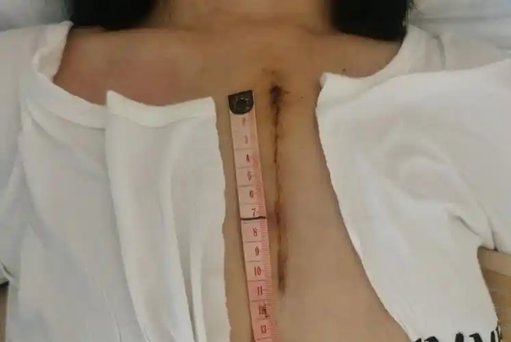 小切口心脏瓣膜手术与传统的开胸手术相比,具有创伤小,恢复快,并发症