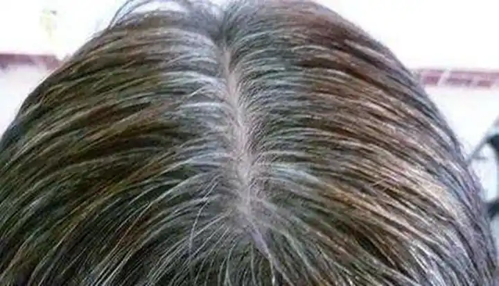 白发长在哪个位置,病就从哪来,教你4招,轻松把头发去白变黑!