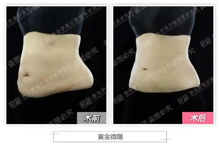 青岛伊美尔黄金微雕有效解决吸脂后皮肤松弛问题