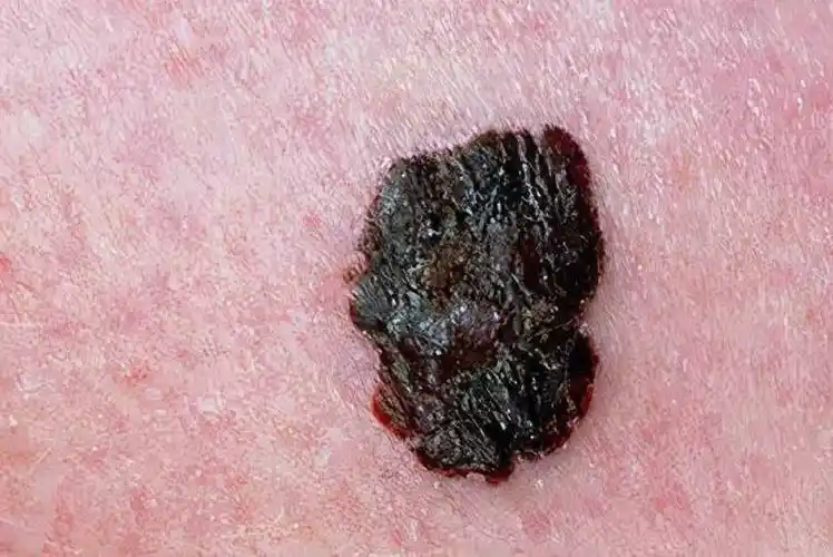 黑色素瘤早期症状