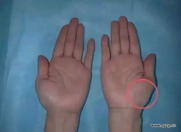 3,严重的会出现大鱼际肌萎缩,拇指对掌功能受限等.