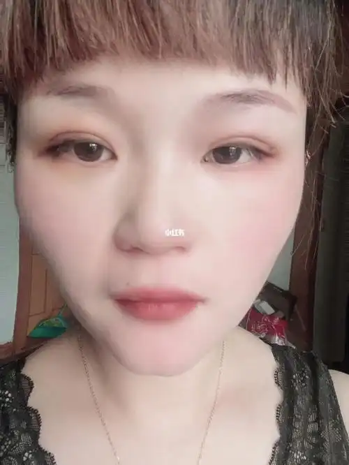 埋线双眼皮恢复