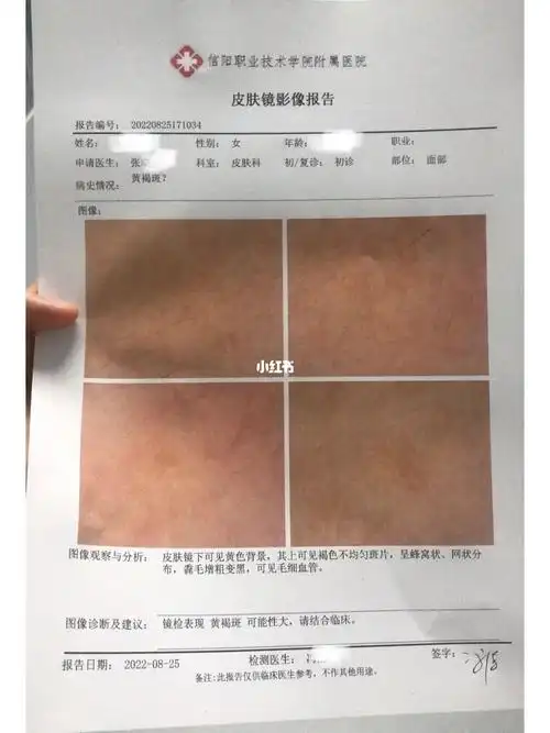 于是今天我就来挂个专家号,医生说可能是黄褐斑,让做个皮肤镜检查