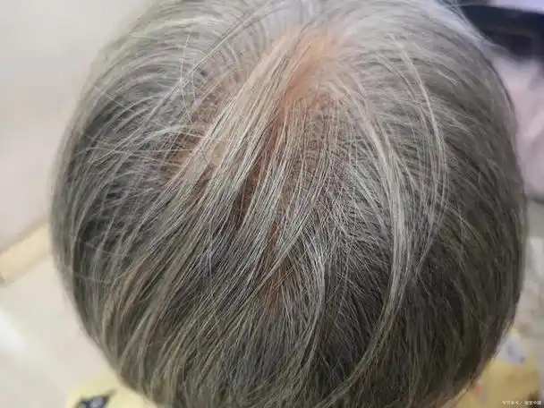 头发是如何变白的?白发位置和疾病的关系你知道吗?