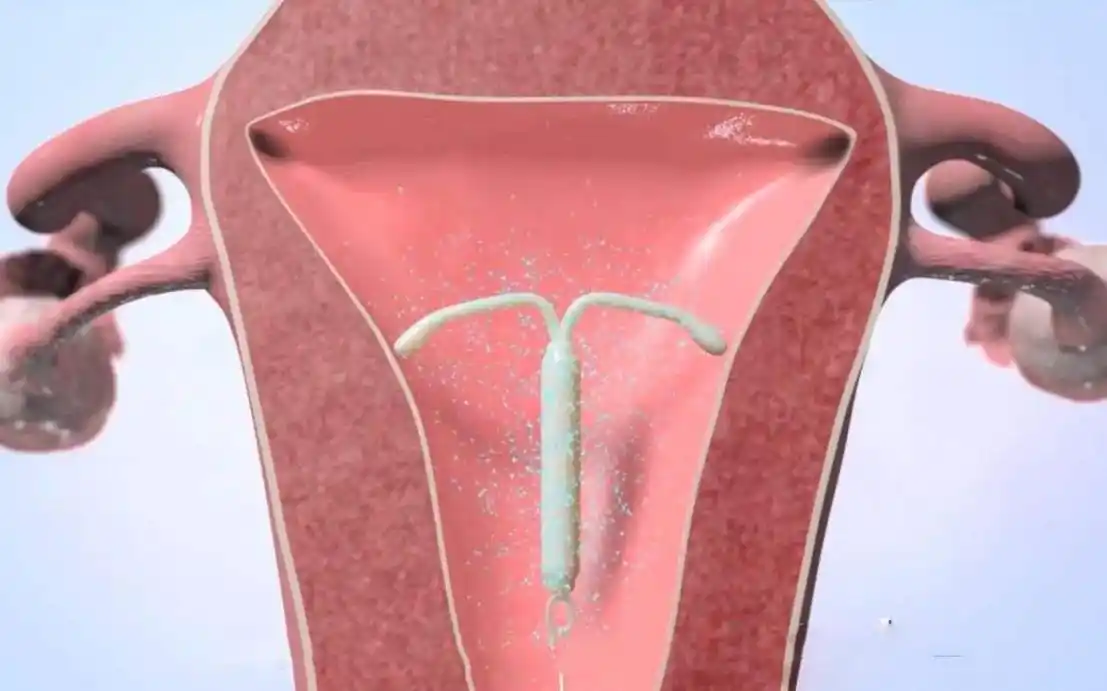 节育环是一个时代的产物,真的有那么可怕吗?我要为它说句公道话