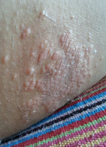 体股癣初期现象图片 (36)