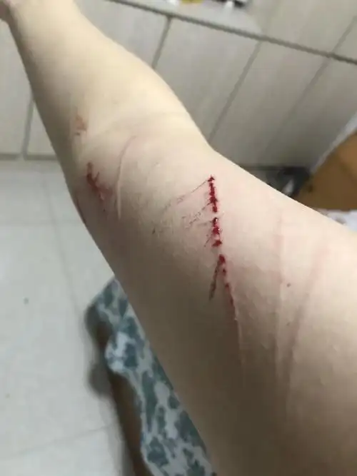 求助家里主子脾气暴躁爱抓人手上全是口子心很凉