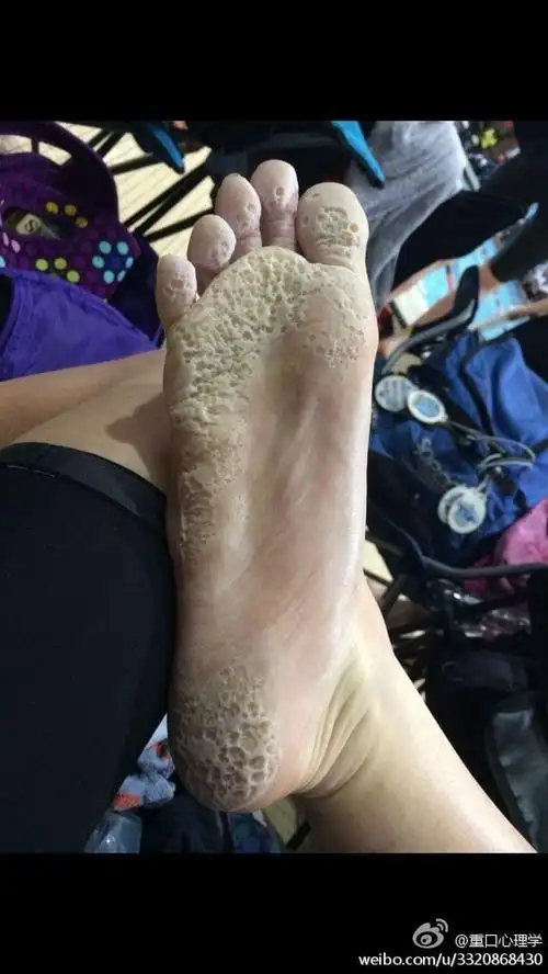 比臭脚更恶心,比烂脚丫更可怕,足蹠蠹蝕症