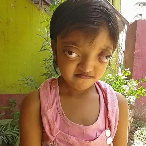 因为近视眼的眼轴比普通人要长,高度近视度数越高眼轴就越长,眼球前后