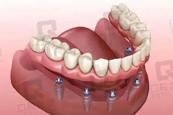 老年人牙齿掉了大部分怎么处理合适?究竟种牙好还是镶牙好呢_口腔久灵