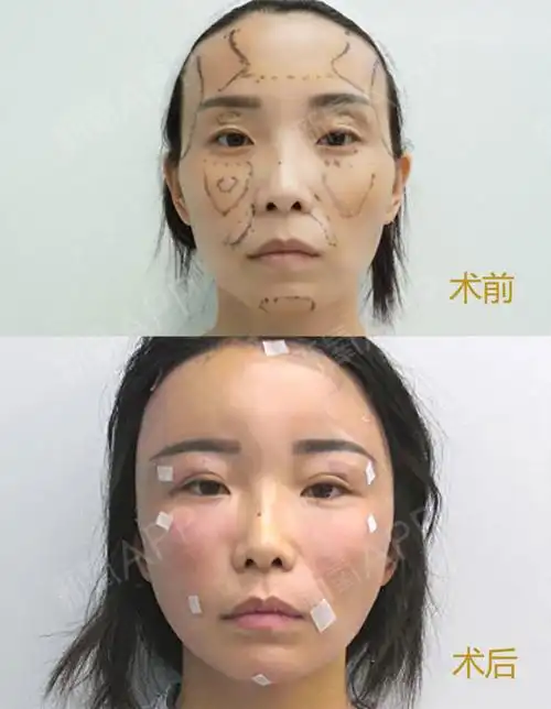 眼窝凹陷非常显老,想通过自体脂肪填充眼窝,效果会好_圈子-新氧美容