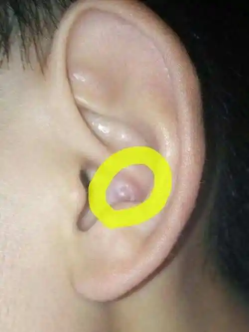 说到这里,很多人还不能分辨什么样子的疙瘩才是耳廓假性囊肿.