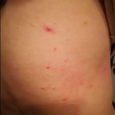 最近发现背部和肚脐周围长出好多小红点,而且很痒,不知道是毛囊炎还是