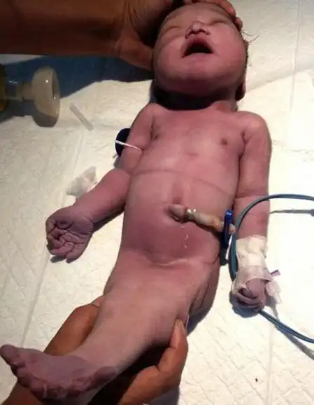 印度女子产下"美人鱼宝宝" 仅4个小时就离世