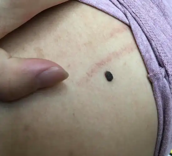 后背有个痣要切除吗