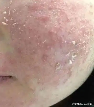 秋冬脸部干燥,化妆卡粉,严重的还会爆皮,不要以为那些直男看不出你们