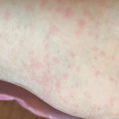 我2个半月得了过敏性湿疹怎么办