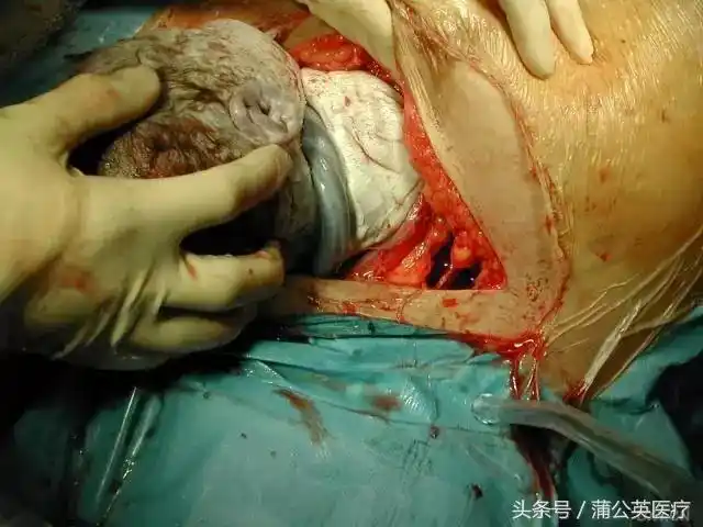 见过剖腹产,你还觉得生孩子简单吗?-搜狐