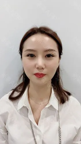 新氧- 大mi | 自体脂肪填充全脸 | 术后当自强 | 深圳同城 | 汕头同城