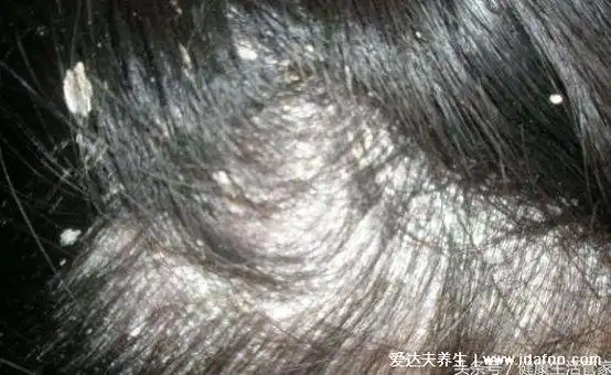 头皮上有白色大片的皮是怎么回事图片,头皮糠疹可造成脱发
