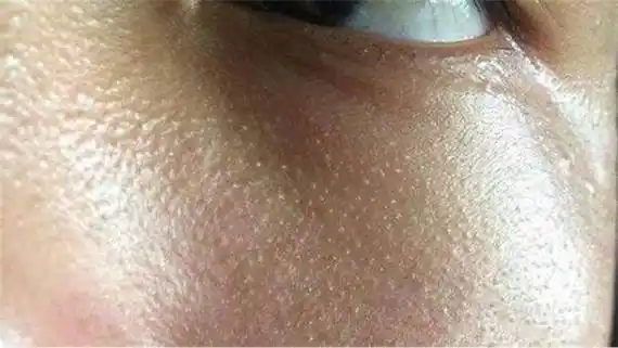 用什么可以去脂肪粒( 用什么东西可以去脂肪粒 )