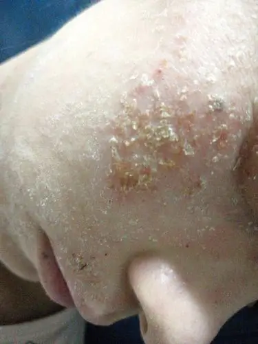 干燥脱皮瘙痒,特应性皮炎,拿什么来拯救你