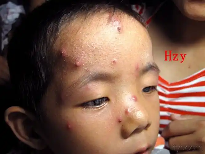 小儿头面上长什么了