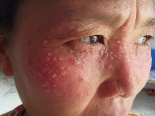 面部皮损,,高清图 - 皮肤及性传播疾病讨论版 - 爱爱医医学论坛