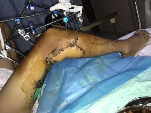 三亚市人民医院成功完成首例琼南地区膝关节离断再植术