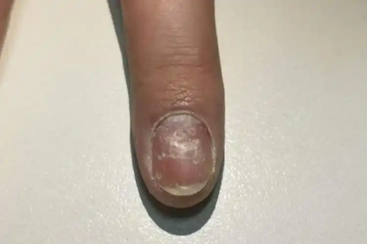 念珠菌性甲真菌病甲母质受损图