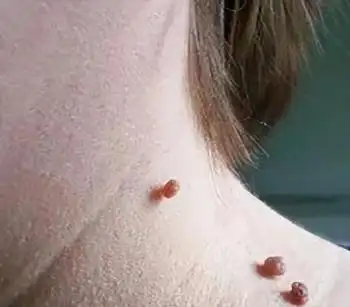 为什么皮肤上会长"小肉粒"?它有什么危害?
