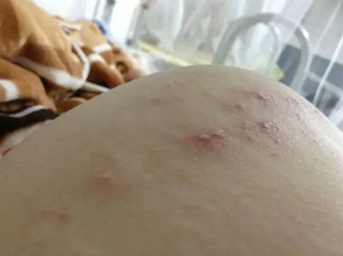 屁股上最近长这个,是什么,怎么办?