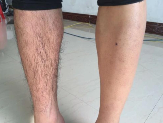 为何有些男生腿毛浓密,有的男生的腿却"一毛不拔"?看完解惑了