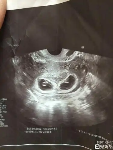 两个宝宝都有胎心胎芽了,很开心