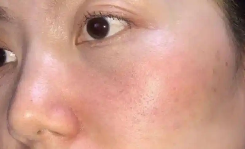 皮肤接触水状护肤品刺痛≠缺水