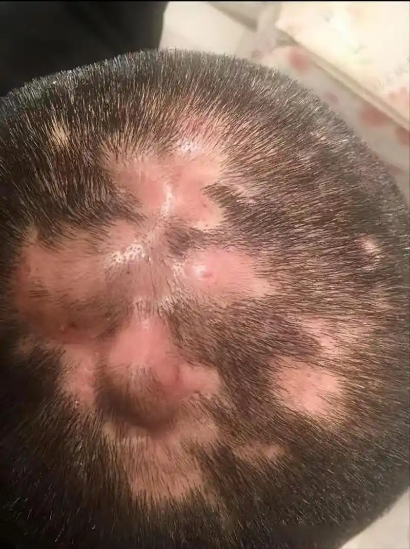 头上脓包此起彼伏,中医辨证,这个夏天不再被毛囊炎所困!