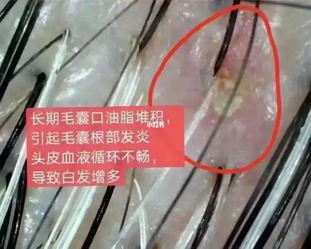 什么叫头皮盲71头皮危害72