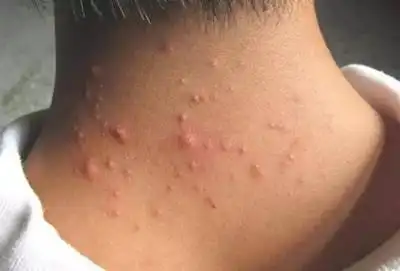 脖子后毛囊炎硬疙瘩怎么消除