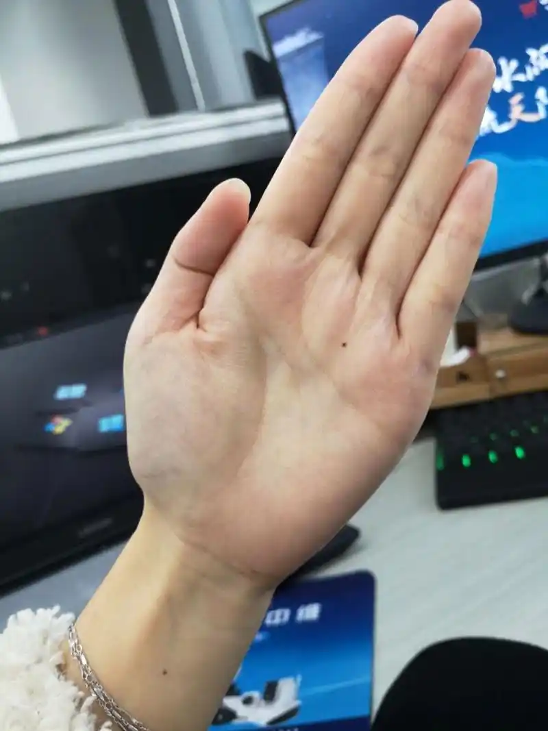 手心突然长了一颗痣